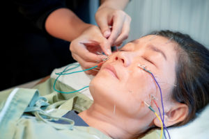 asian woman undergoing of acupuncture beauty face treatment by electric needle equipment